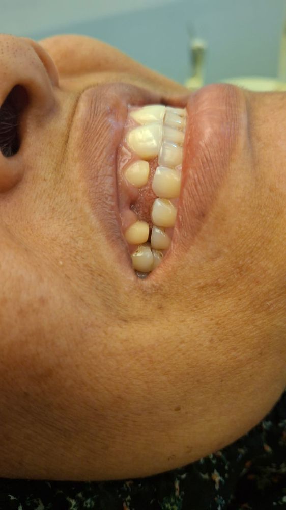 Worn Teeth Restored with Crowns — before treatment