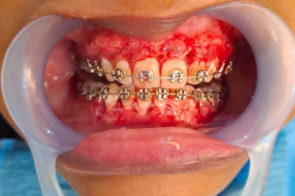 Blackish Gum Treatment — after treatment