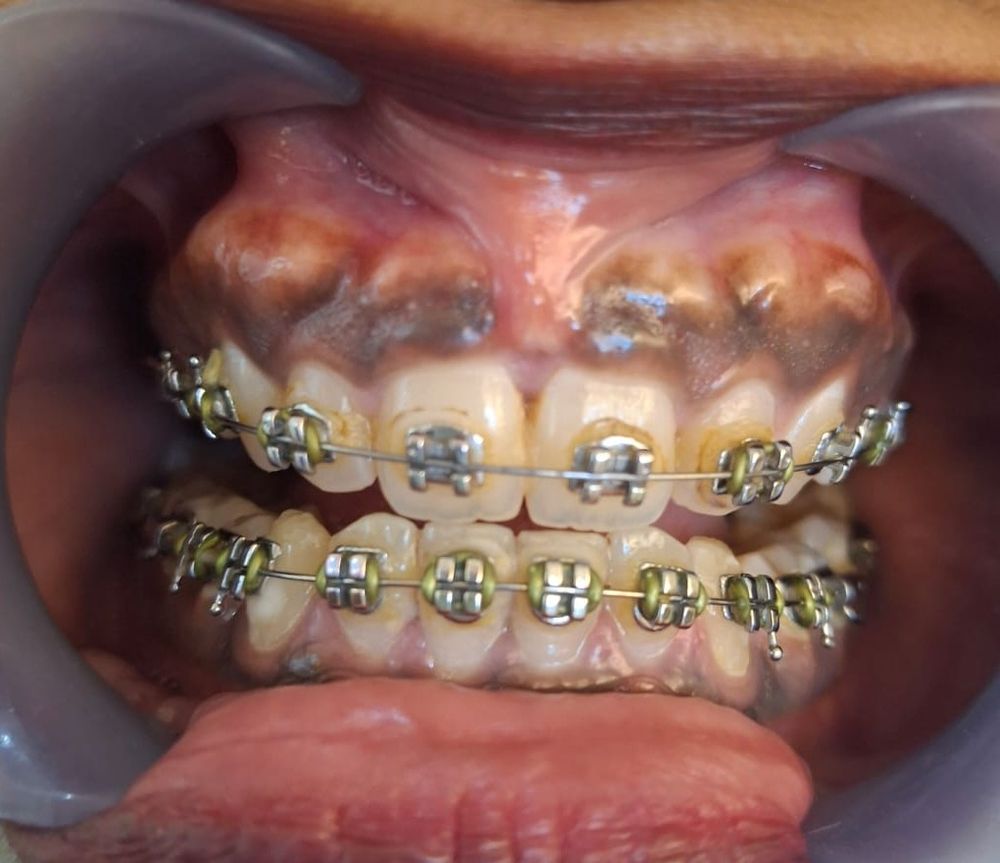 Blackish Gum Treatment — before treatment